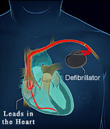 Katy Texas Defibrillator (ICD) Placement